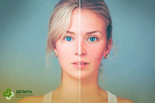 На половине фото у девушки здоровая кожа, на другой половине - плохая